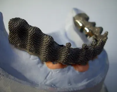 Fabrication de prothèse dentaire à Jodoigne